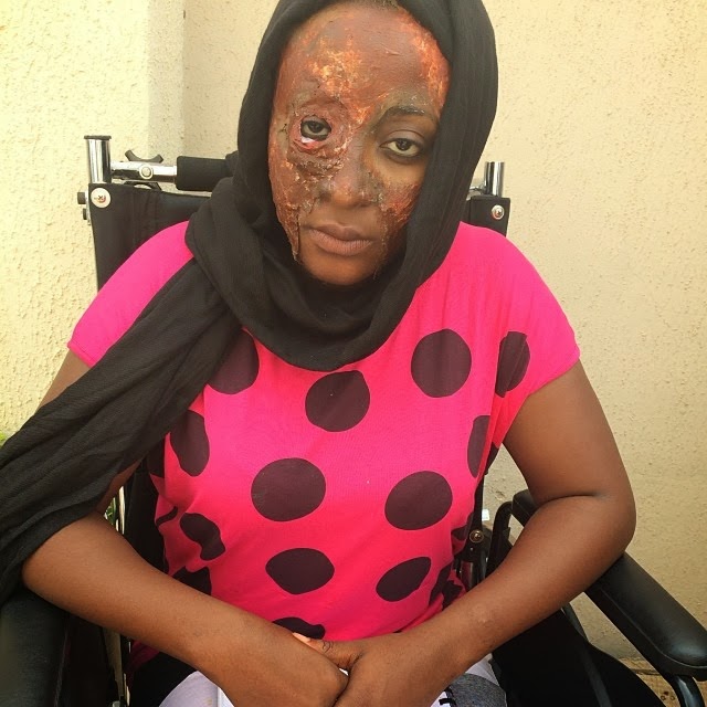 Ini Edo acid attack face
