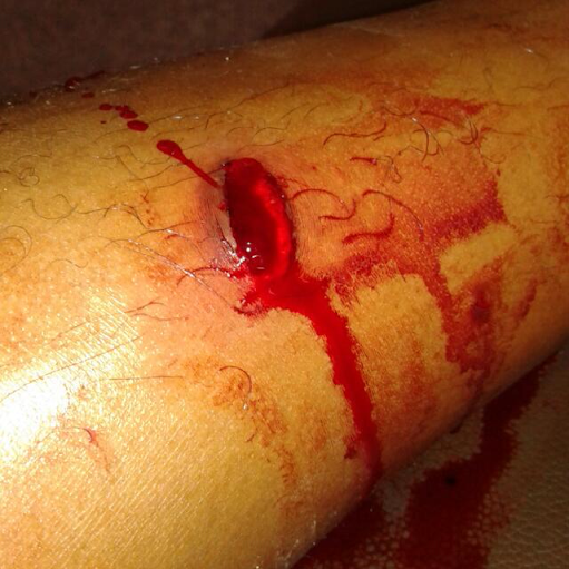 3in1 leg wound